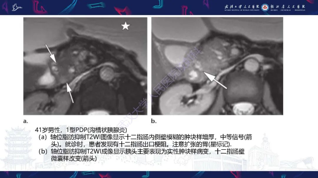 影像PPT - 【PPT】慢性胰腺炎与胰腺肿瘤影像鉴别诊断-40