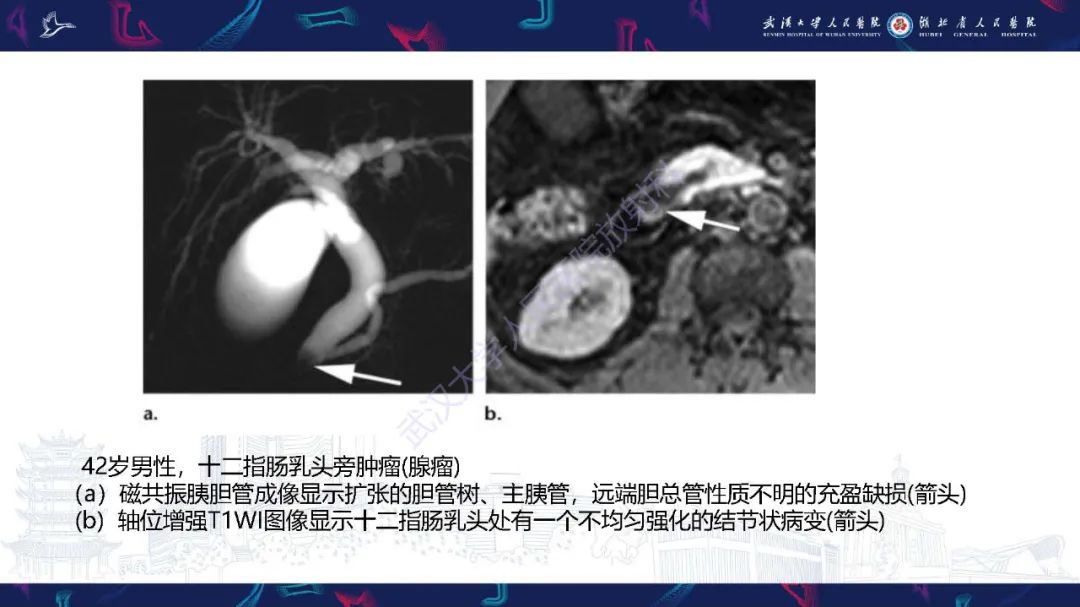 影像PPT - 【PPT】慢性胰腺炎与胰腺肿瘤影像鉴别诊断-45