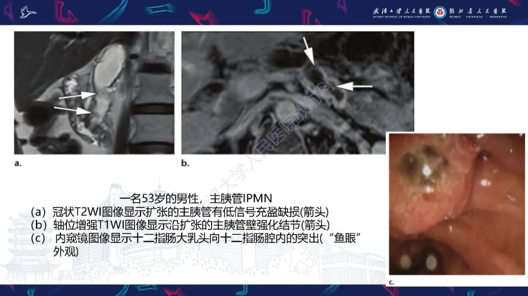 影像PPT - 【PPT】慢性胰腺炎与胰腺肿瘤影像鉴别诊断-46