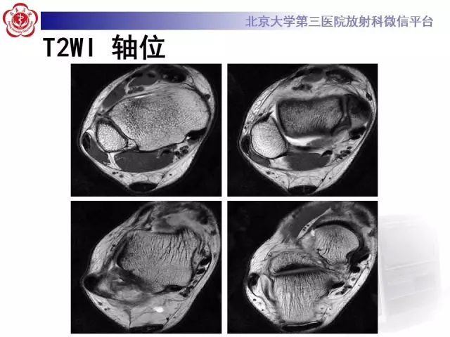 影像PPT - 【PPT】腓骨肌腱脱位的影像-3