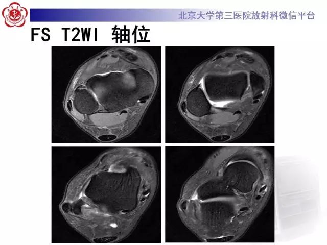 影像PPT - 【PPT】腓骨肌腱脱位的影像-4