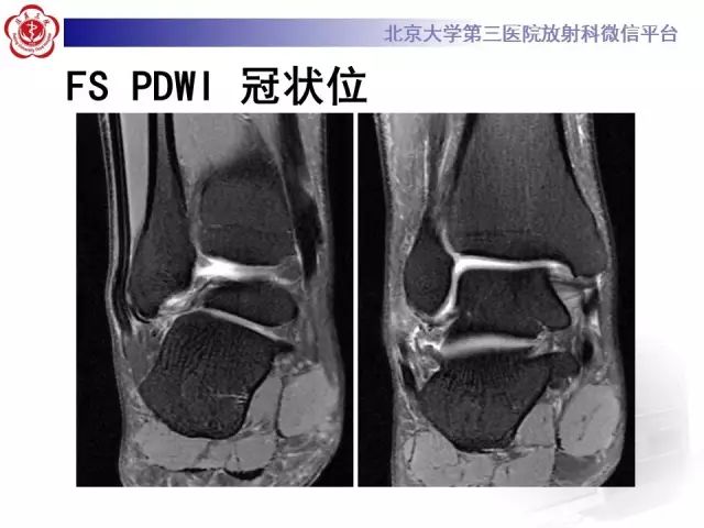影像PPT - 【PPT】腓骨肌腱脱位的影像-5