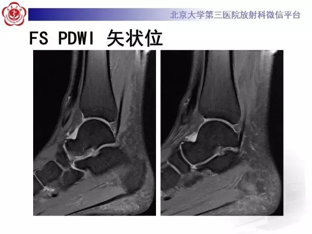 影像PPT - 【PPT】腓骨肌腱脱位的影像-6