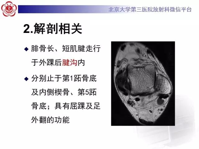 影像PPT - 【PPT】腓骨肌腱脱位的影像-12
