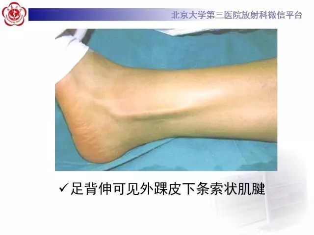 影像PPT - 【PPT】腓骨肌腱脱位的影像-19
