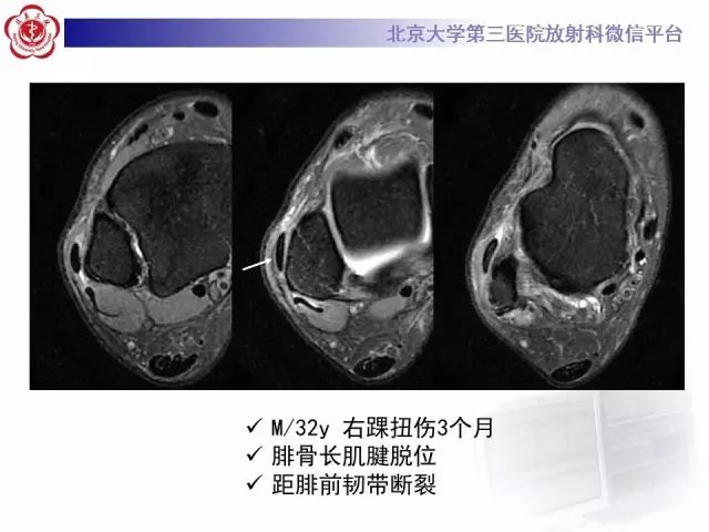 影像PPT - 【PPT】腓骨肌腱脱位的影像-21
