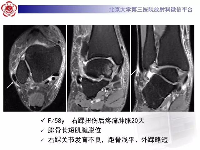 影像PPT - 【PPT】腓骨肌腱脱位的影像-23