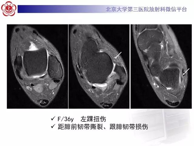 影像PPT - 【PPT】腓骨肌腱脱位的影像-27