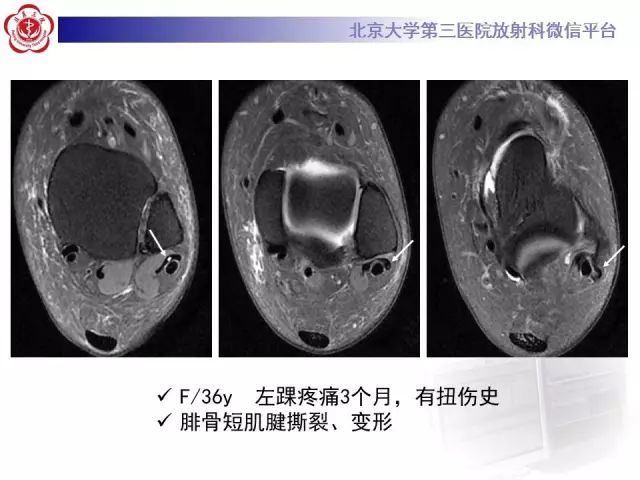 影像PPT - 【PPT】腓骨肌腱脱位的影像-29