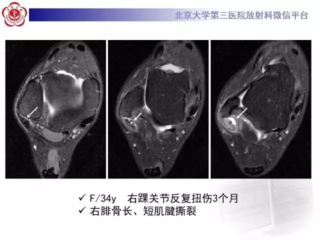 影像PPT - 【PPT】腓骨肌腱脱位的影像-30