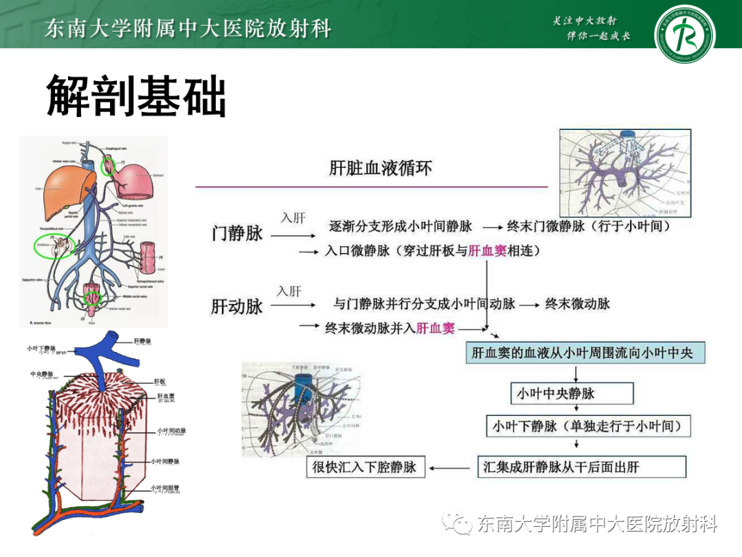 影像PPT - 【PPT】肝窦阻塞综合征的影像-4