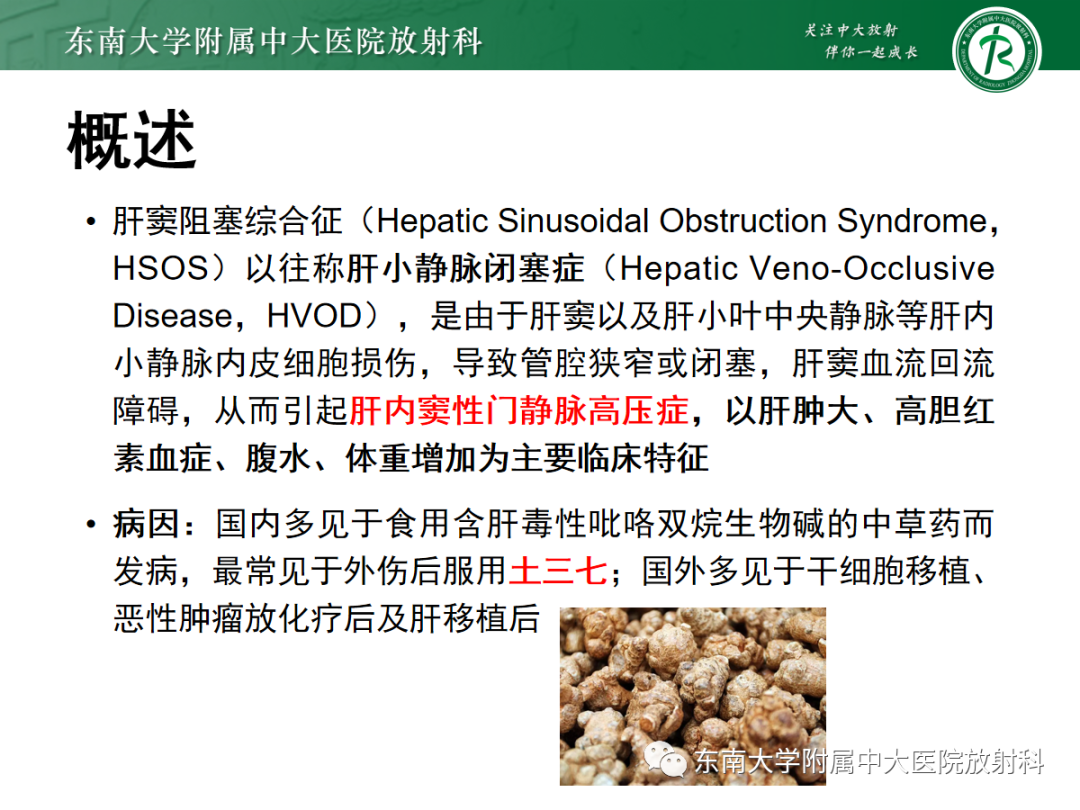 影像PPT - 【PPT】肝窦阻塞综合征的影像-3