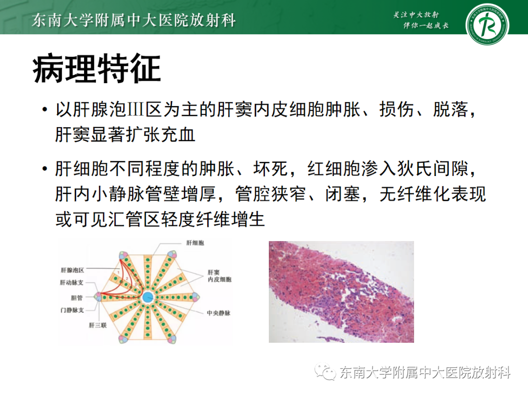 影像PPT - 【PPT】肝窦阻塞综合征的影像-6