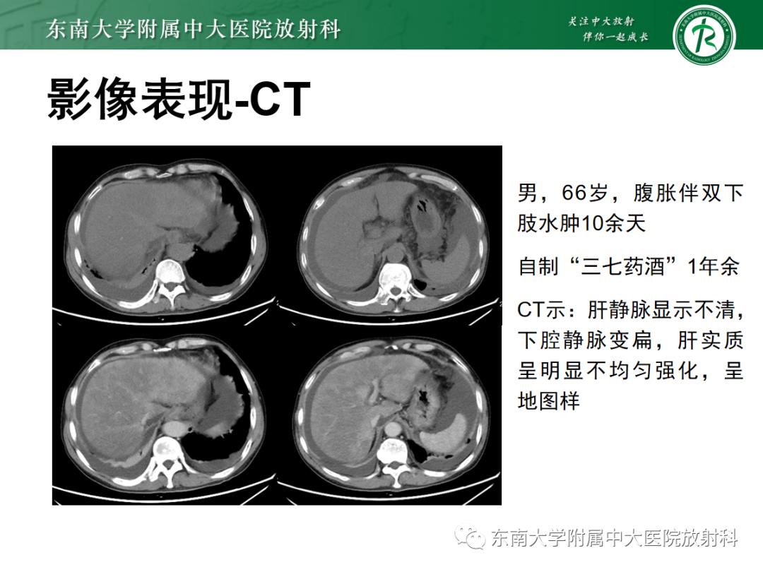 影像PPT - 【PPT】肝窦阻塞综合征的影像-11