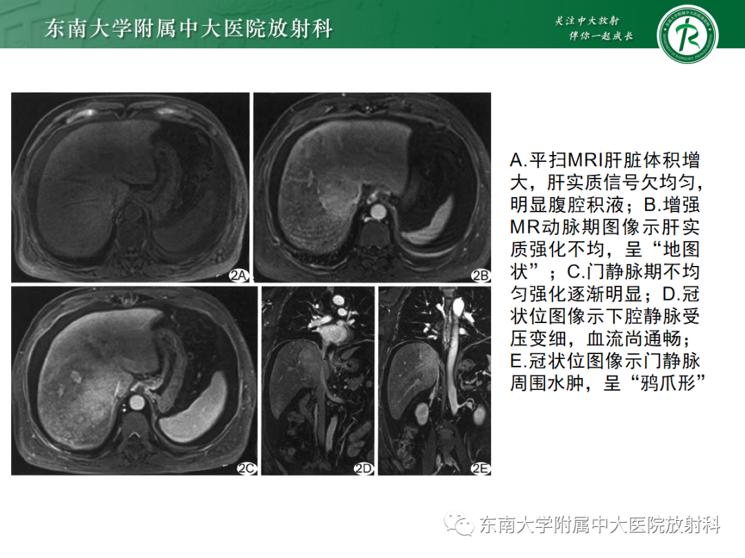 影像PPT - 【PPT】肝窦阻塞综合征的影像-13