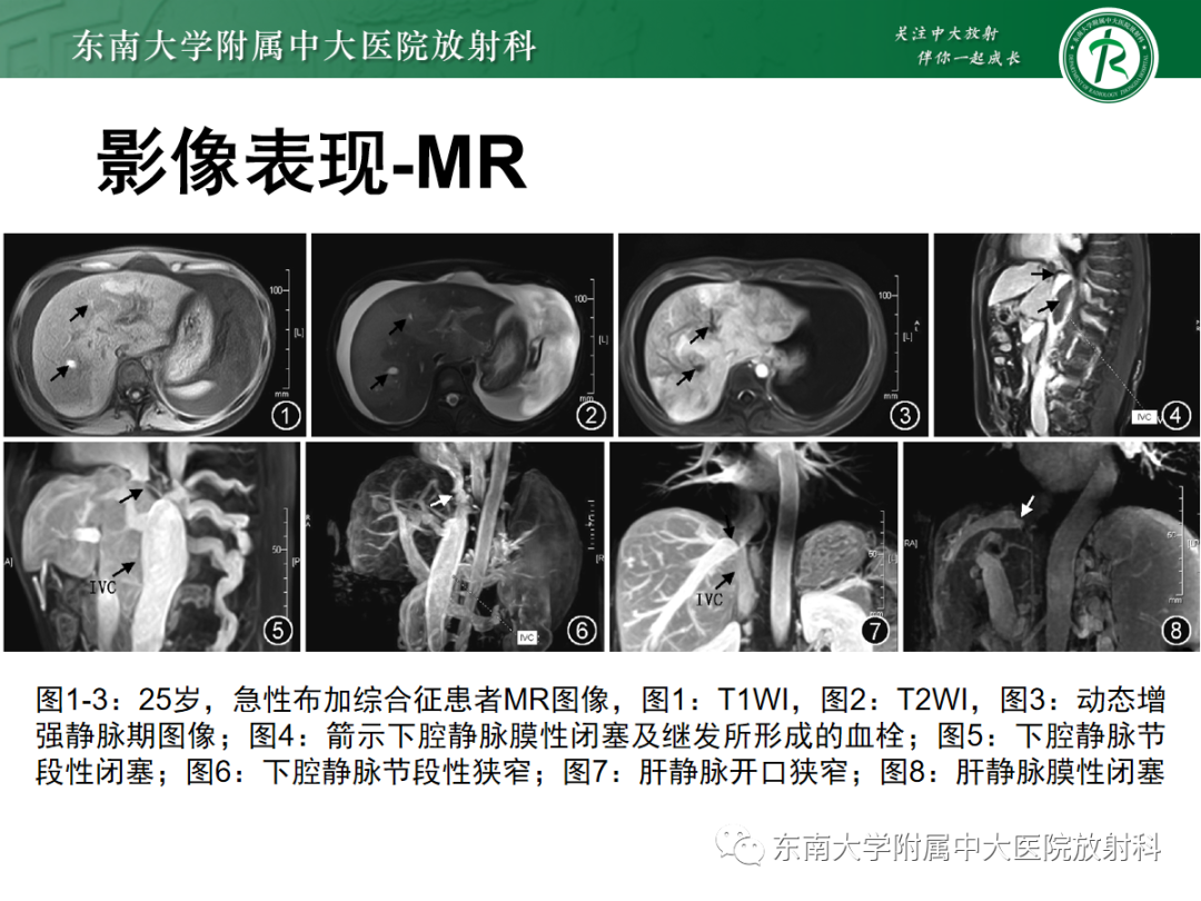 影像PPT - 【PPT】肝窦阻塞综合征的影像-22