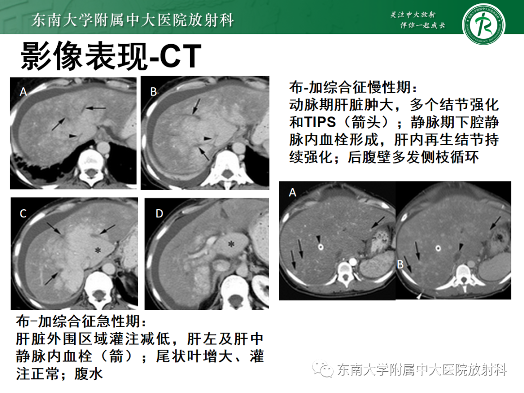 影像PPT - 【PPT】肝窦阻塞综合征的影像-20