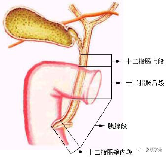 影像PPT - 胆管解剖、变异及先天性胆管扩张症-4 影像PPT - 胆管解剖、变异及先天性胆管扩张症-4