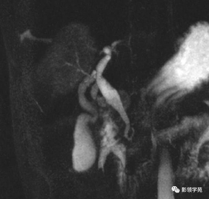 影像PPT - 胆管解剖、变异及先天性胆管扩张症-8 影像PPT - 胆管解剖、变异及先天性胆管扩张症-8