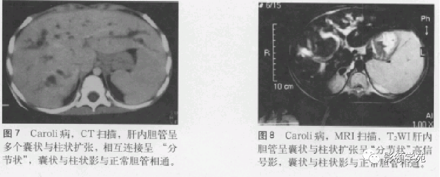 影像PPT - 胆管解剖、变异及先天性胆管扩张症-21 影像PPT - 胆管解剖、变异及先天性胆管扩张症-21