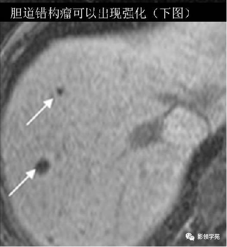 影像PPT - 胆管解剖、变异及先天性胆管扩张症-26 影像PPT - 胆管解剖、变异及先天性胆管扩张症-26