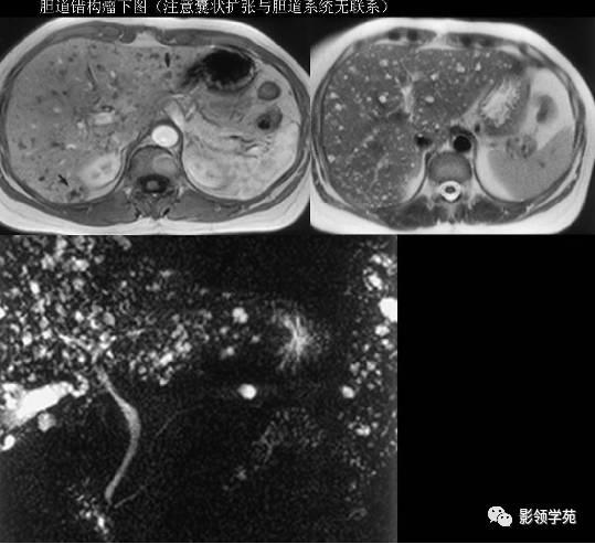 影像PPT - 胆管解剖、变异及先天性胆管扩张症-25 影像PPT - 胆管解剖、变异及先天性胆管扩张症-25