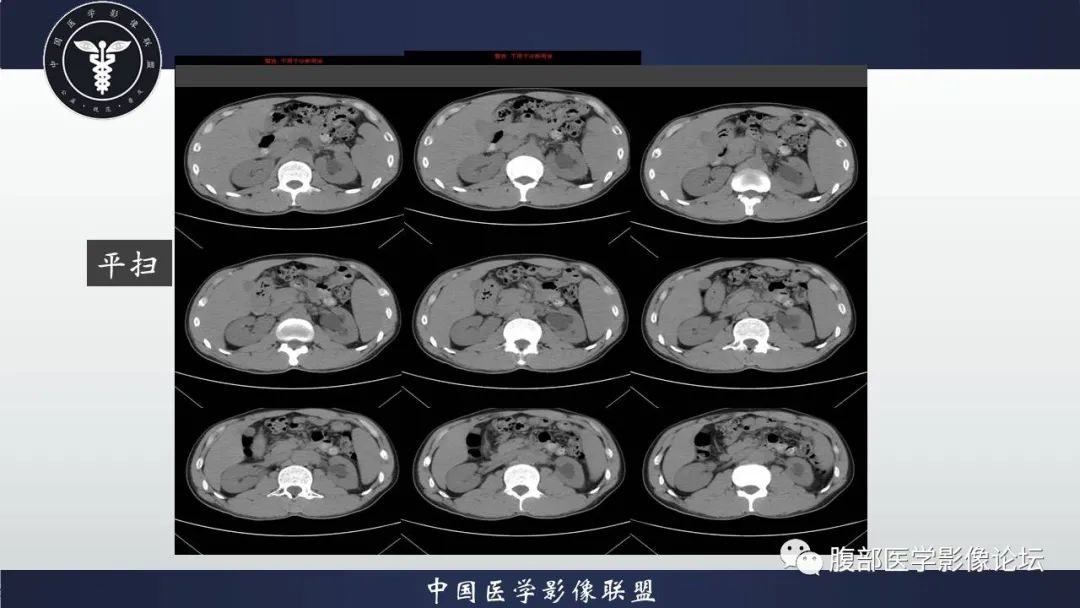 影像PPT - 【病例】腹膜后纤维化VS淋巴瘤-3