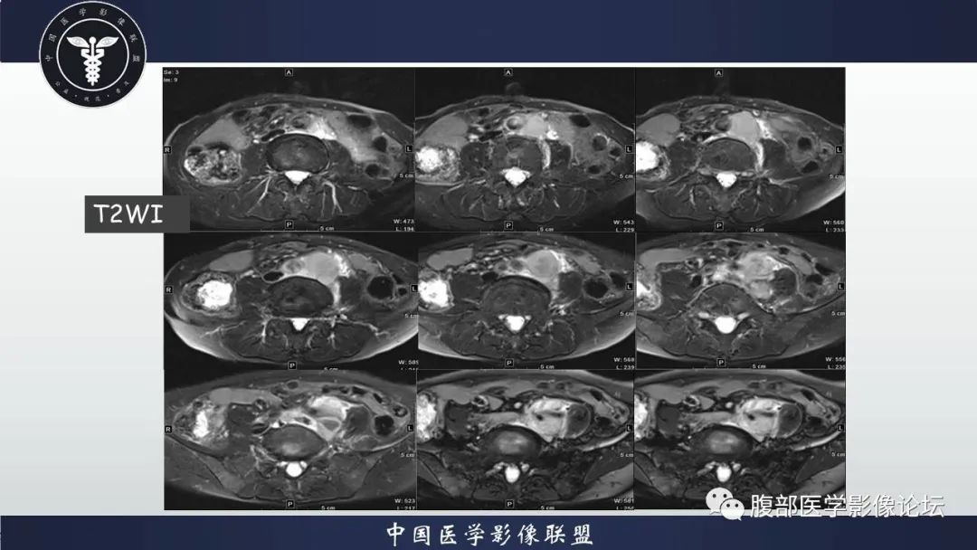 影像PPT - 【病例】腹膜后纤维化VS淋巴瘤-7