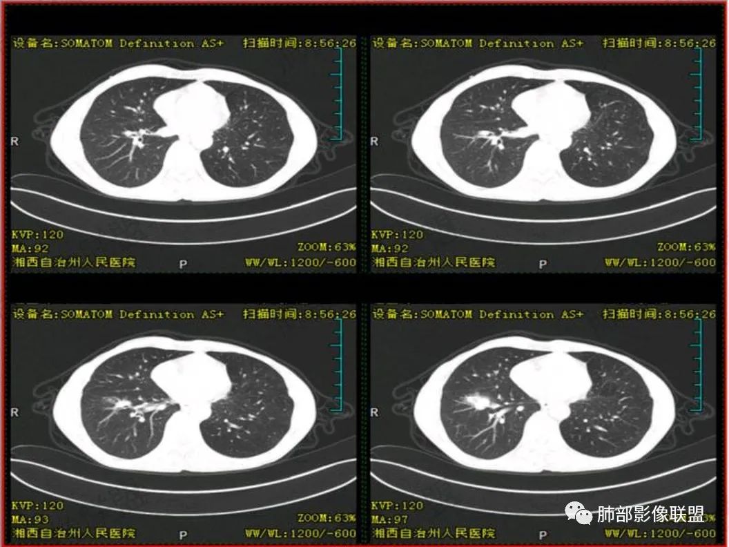 影像PPT - 【病例】 cyfra21-1?鉴别“鳞癌”与“结核”给您高招-10 影像PPT - 【病例】 cyfra21-1?鉴别“鳞癌”与“结核”给您高招-10