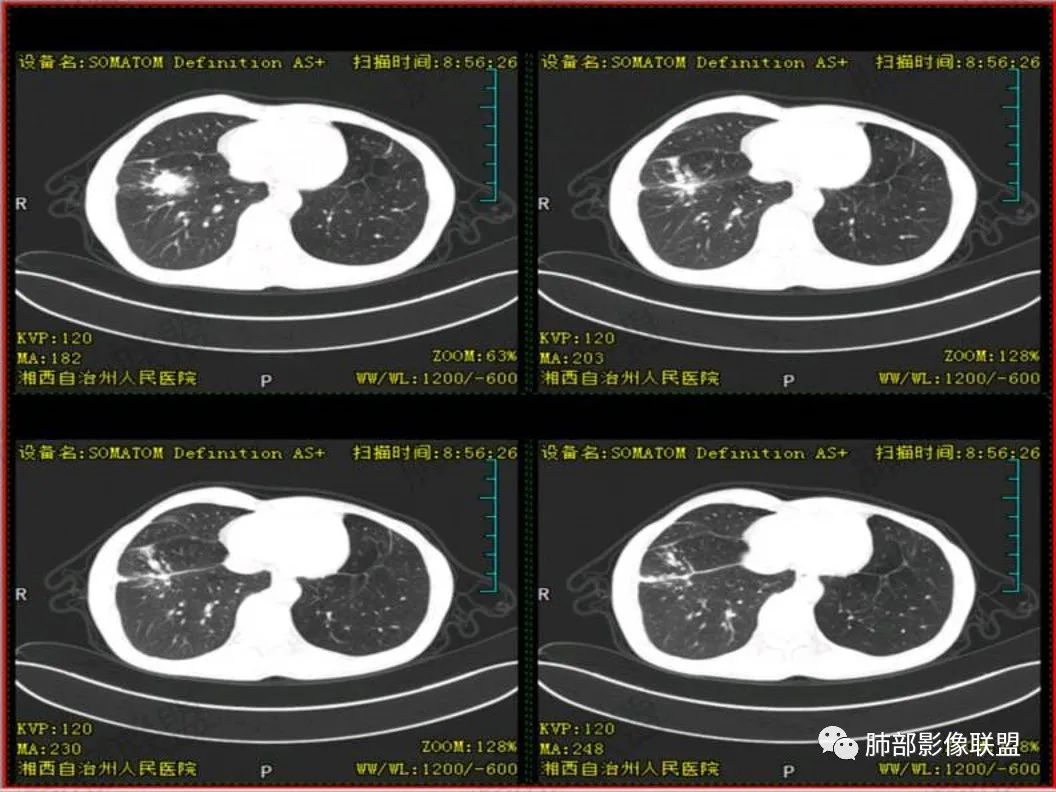 影像PPT - 【病例】 cyfra21-1?鉴别“鳞癌”与“结核”给您高招-12 影像PPT - 【病例】 cyfra21-1?鉴别“鳞癌”与“结核”给您高招-12