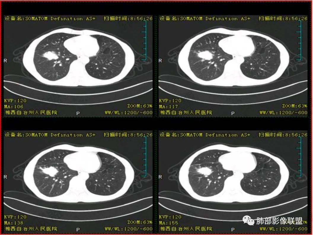 影像PPT - 【病例】 cyfra21-1?鉴别“鳞癌”与“结核”给您高招-11 影像PPT - 【病例】 cyfra21-1?鉴别“鳞癌”与“结核”给您高招-11