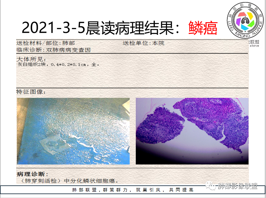 影像PPT - 【病例】 cyfra21-1?鉴别“鳞癌”与“结核”给您高招-26 影像PPT - 【病例】 cyfra21-1?鉴别“鳞癌”与“结核”给您高招-26