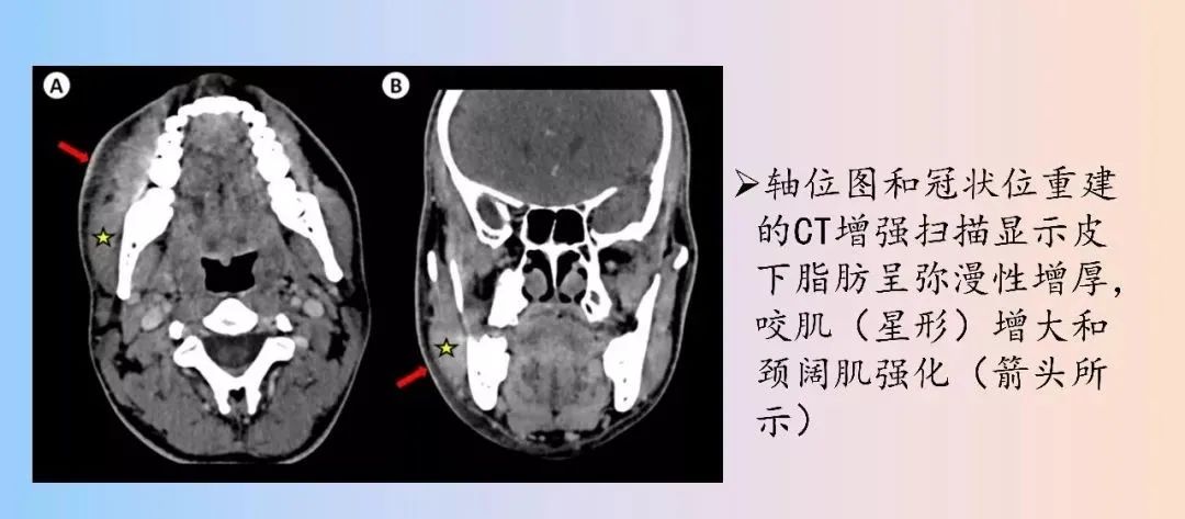 影像PPT - 【PPT】颈深部间隙感染的CT成像-15 影像PPT - 【PPT】颈深部间隙感染的CT成像-15