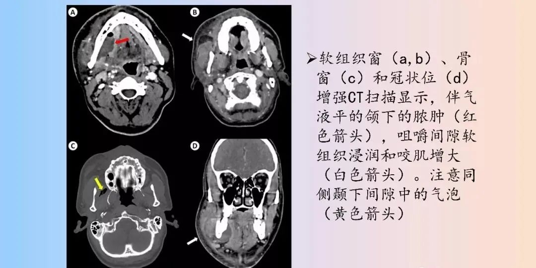 影像PPT - 【PPT】颈深部间隙感染的CT成像-16 影像PPT - 【PPT】颈深部间隙感染的CT成像-16