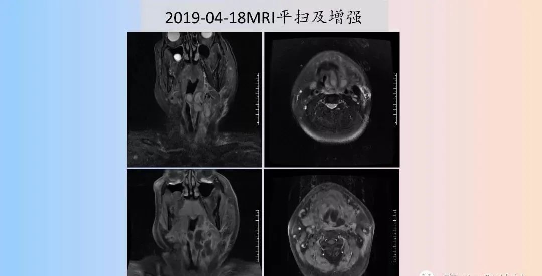 影像PPT - 【PPT】颈深部间隙感染的CT成像-23 影像PPT - 【PPT】颈深部间隙感染的CT成像-23