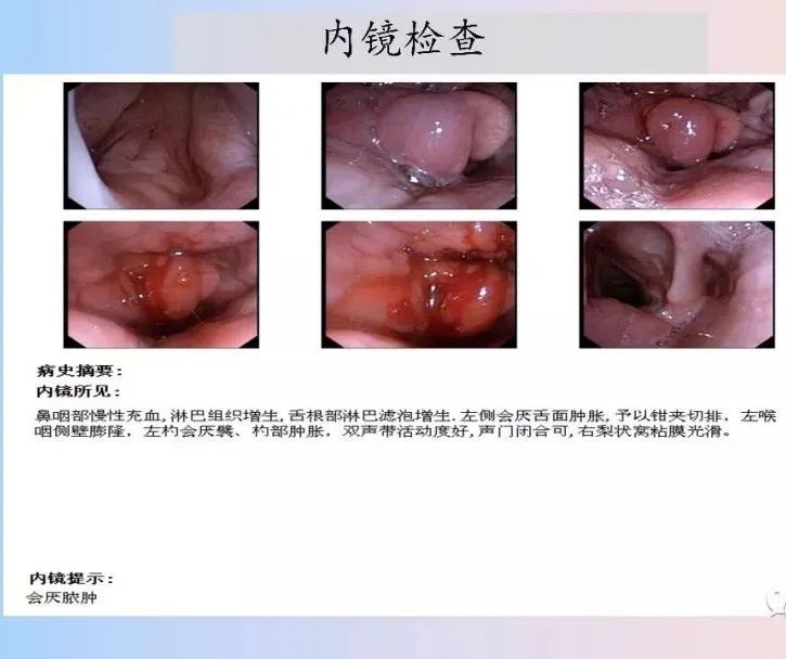 影像PPT - 【PPT】颈深部间隙感染的CT成像-25 影像PPT - 【PPT】颈深部间隙感染的CT成像-25