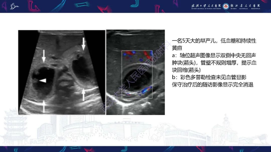 影像PPT - 【PPT】肾上腺出血影像诊断-10