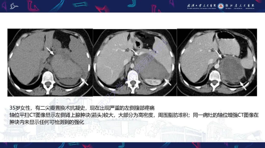 影像PPT - 【PPT】肾上腺出血影像诊断-12