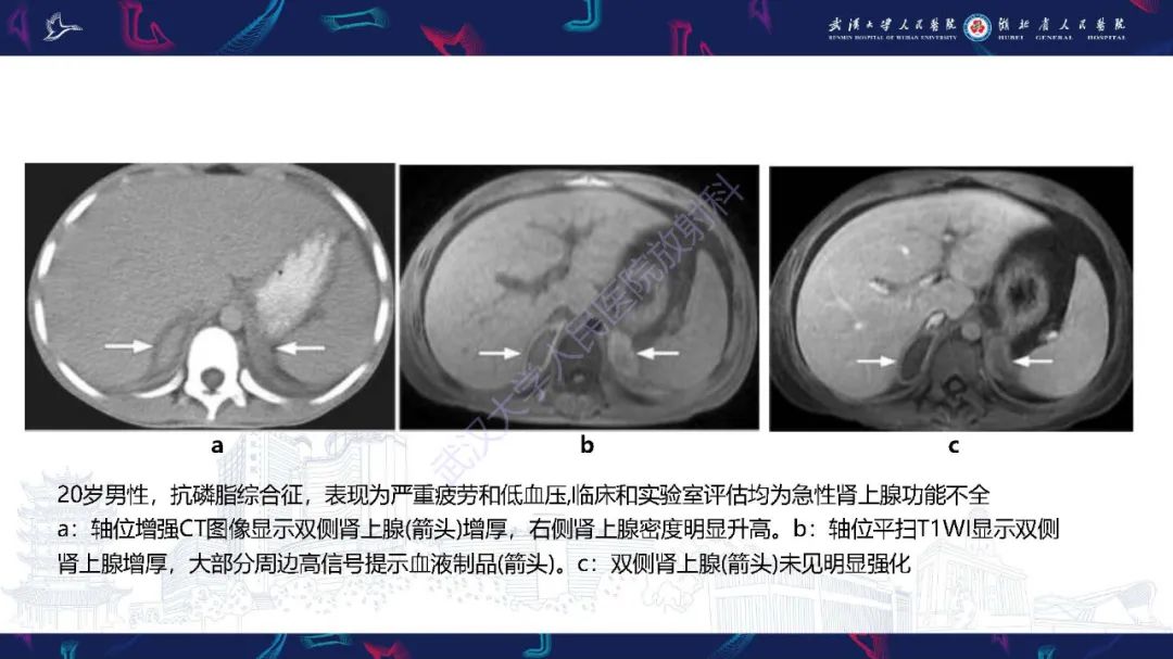 影像PPT - 【PPT】肾上腺出血影像诊断-15