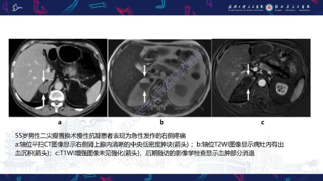 影像PPT - 【PPT】肾上腺出血影像诊断-13