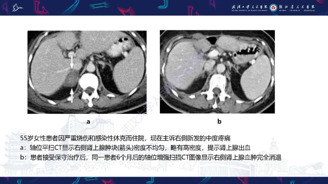 影像PPT - 【PPT】肾上腺出血影像诊断-17