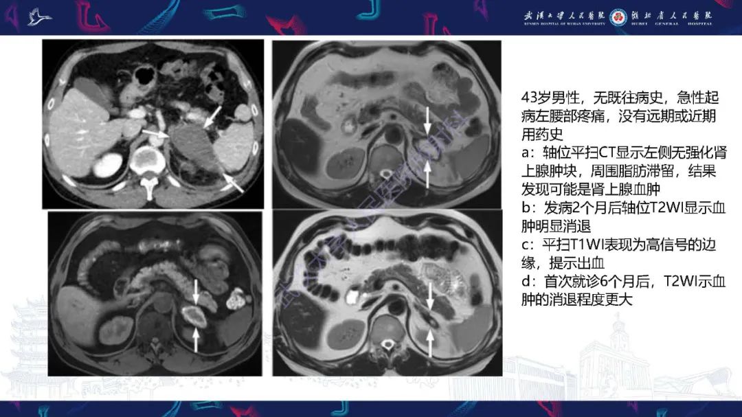 影像PPT - 【PPT】肾上腺出血影像诊断-19