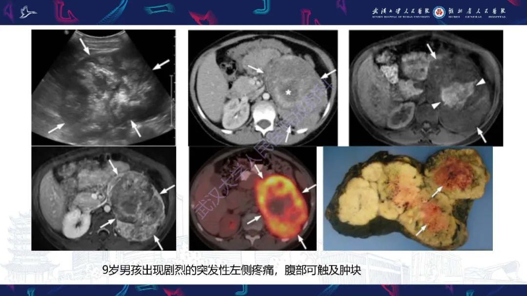 影像PPT - 【PPT】肾上腺出血影像诊断-23