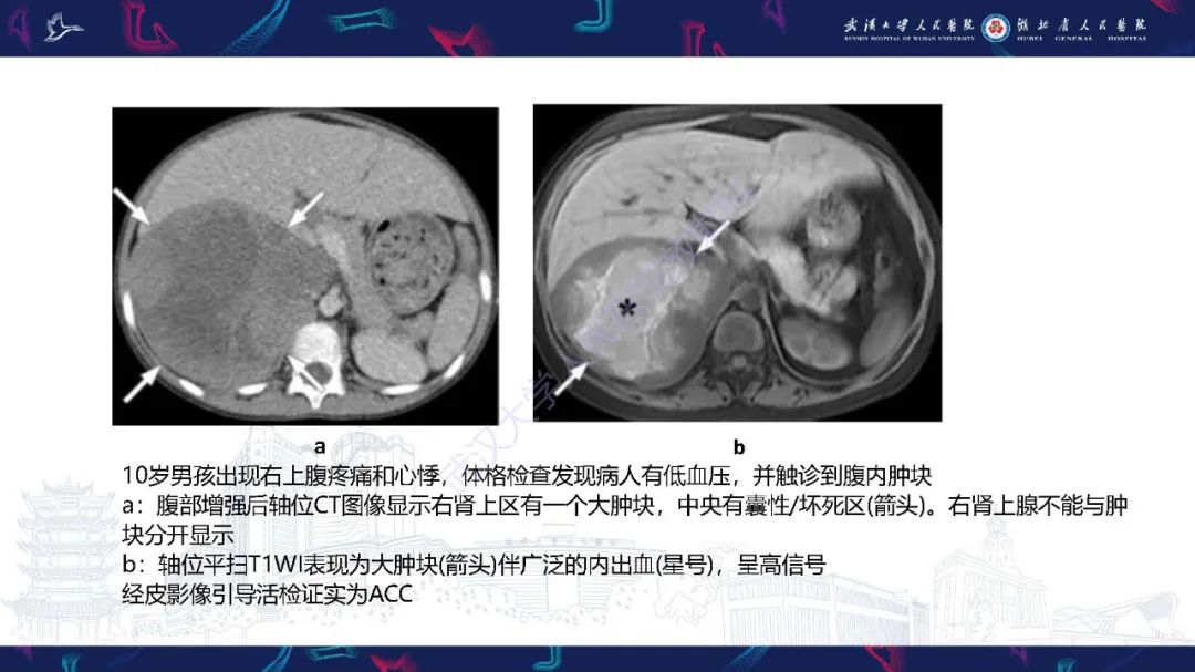 影像PPT - 【PPT】肾上腺出血影像诊断-24