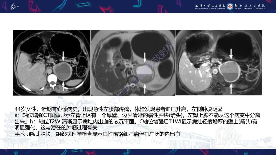 影像PPT - 【PPT】肾上腺出血影像诊断-27