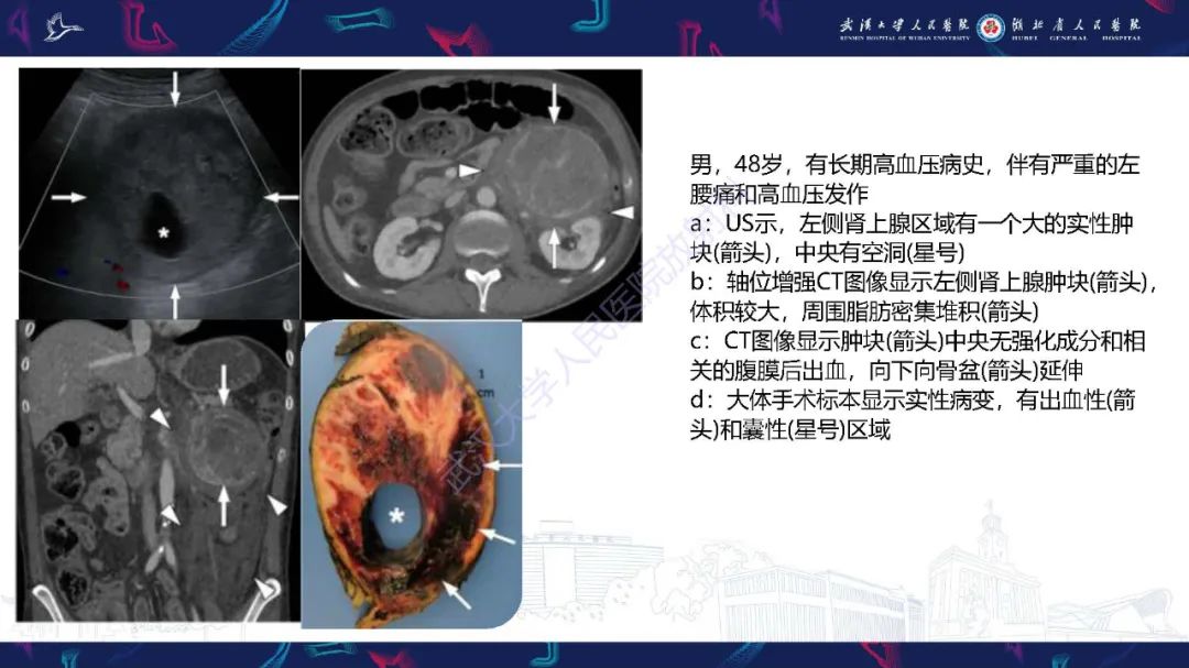 影像PPT - 【PPT】肾上腺出血影像诊断-26