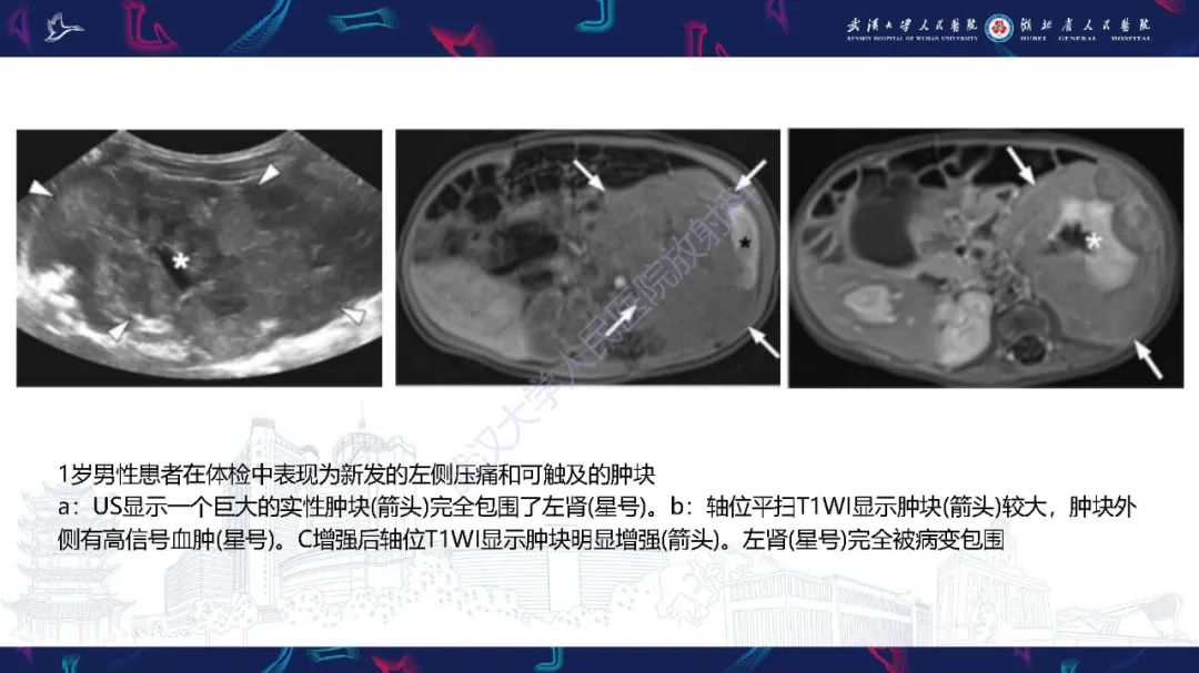 影像PPT - 【PPT】肾上腺出血影像诊断-29