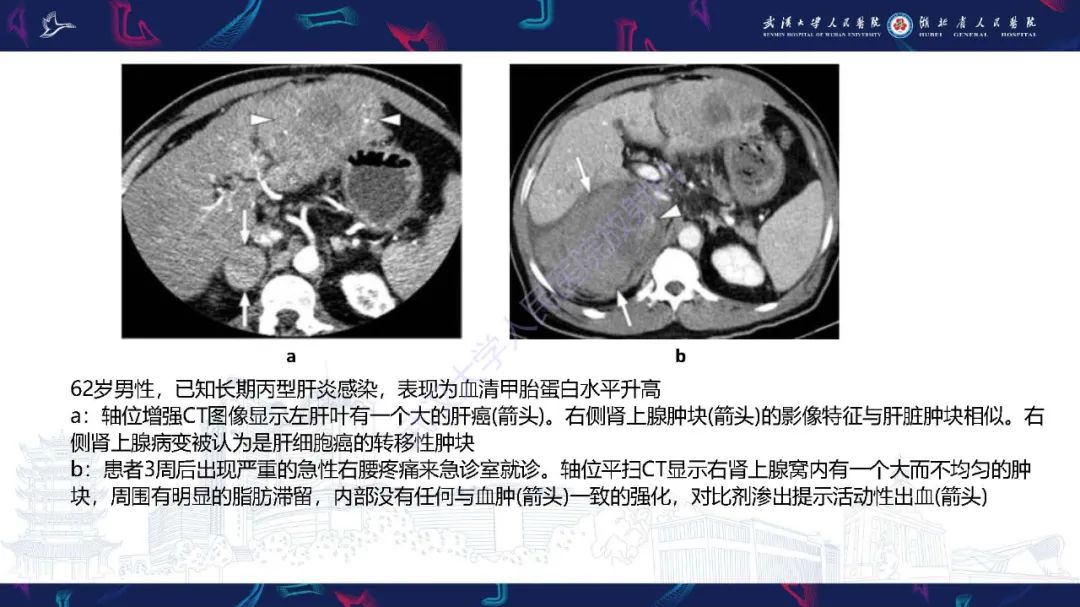 影像PPT - 【PPT】肾上腺出血影像诊断-31
