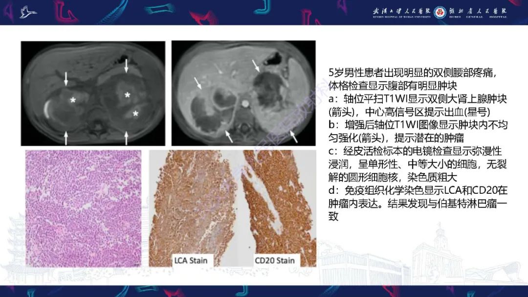 影像PPT - 【PPT】肾上腺出血影像诊断-33