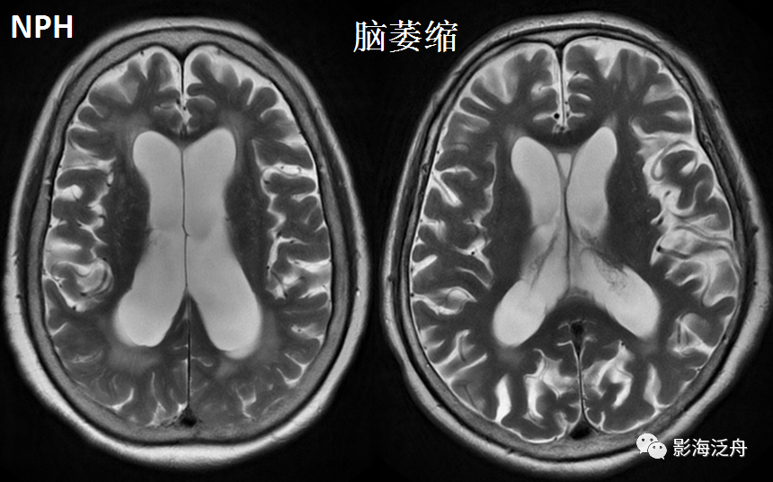 影像PPT - 【病例】小心误诊,这可不是单纯的脑萎缩!-11 影像PPT - 【病例】小心误诊,这可不是单纯的脑萎缩!-11